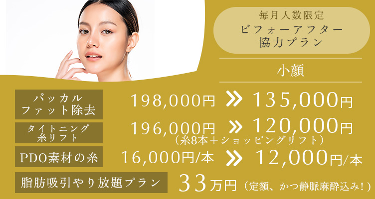 毎月人数限定 ビフォーアフター協力プラン。バッカルファット除去 198,000円→135,000円 タイトニング糸リフト(糸8本+ショッピングリフト) 196,000円→120,000円 PDO素材の糸 16,000円/本→12,000円/本 脂肪吸引やり放題プラン 33万円 定額、かつ静脈麻酔込み! ※全てモニター価格