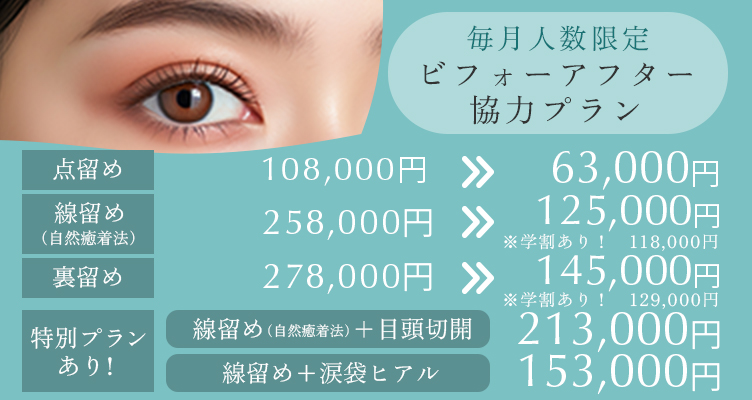 毎月人数限定 ビフォーアフター協力プラン。線留め+涙袋ヒアル→153,000円 点留め98,000円→63,000円 線留め(自然癒着法)258,000円→125,000円 ※学割あり118.000円 裏留め278,000円→145,000円camp_bna06_250415 ※学割あり129.000円 特別プランあり 線止め+目頭切開 213,000円