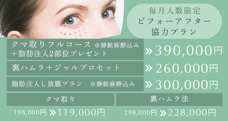 毎月人数限定 ビフォーアフター協力プラン。クマ取りフルコース+脂肪注入2部位プレゼント※静脈麻酔込み 390,000円 裏ハムラ+ジャルプロセット260,000円 脂肪注入し放題プラン※静脈麻酔込み 300,000円 クマ取り 198,000円→119,000円 裏ハムラ法 298,000円→228,000円