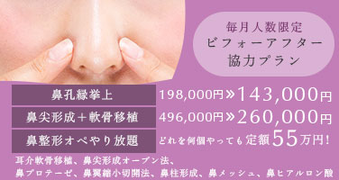 毎月人数限定 ビフォーアフター協力プラン。鼻孔縁挙上198,000円→143,000円 軟骨移植+鼻尖形成496,000円→260,000円 鼻整形オペやり放題定額55万円 耳介軟骨移植、鼻尖形成オープン法、鼻プロテーゼ、鼻翼縮小切開法、鼻柱形成、鼻メッシュ、鼻ヒアルロン酸
