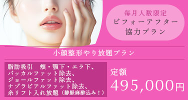 毎月人数限定 ビフォーアフター協力プラン。脂肪吸引 頬・顎下・エラ下、バッカルファット除去、ジョールファット除去、ナゾラビアルファット除去、糸リフト入れ放題、定額495,000円